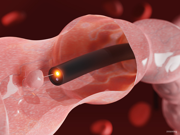 Screening for Early Detection