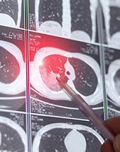 Cancer Screening for Early Detection – CPR26